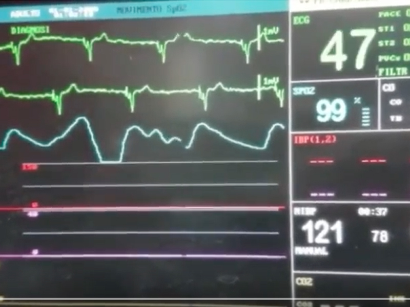Cosa succede se il pacemaker perde colpi?